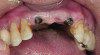 Figure 18. Implants replacing three anterior teeth.