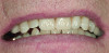 Figure 19. Final implant-supported bridge with no high esthetic demands.