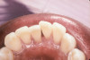 Fig 12. Mandibular canines and incisors treatment planned for fiber splinting to control tooth mobility.