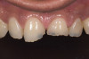 Figure 6  1:1 view demonstrating severe loss of tooth structure due to palatal erosion.