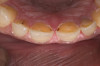 Figure 7  Palatal surface showing loss of form due to enamel dissolution.