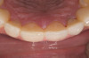 Figure 18  1:1 view of restored palatal surfaces with nanofilled resin.