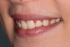 The patient was unhappy with the shape, size, color, and contours of her front teeth.