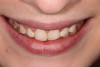 The incisal edge position of tooth No. 8 was used as a reference point.