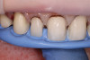 Preparation guide made from wax-up for proper incisal edge thickness.
