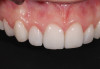 Final anterior porcelain veneers.