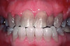 AT-HOME TREATMENT (1.) Teeth with tetracycline stains before whitening treatment.