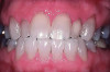 (2.) The teeth shown in Figure 1 whitened with 10% carbamide peroxide for 6 months. (Both photographs courtesy of Marcos Vargas, DDS, MS. Originally published in: da Costa JB. The Tooth-Whitening Process: An Update. Compend Contin Educ Dent. 2012;33(10). Used with permission.)