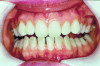 (4.) Following approximately 10 days of at-home tray whitening. (Both photographs courtesy of Kimberly Marshall, DDS. Originally published in: Marshall K, Berry TG, Woolum J. Teeth Whitening Considerations. Inside Dental Assisting. 2012;8(1). Used with permission.)