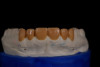 Fig 1. Diagnostic wax-up for a proposed restorative case, Nos. 6 through 11.