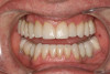 Fig 5. Definitive restorations, full-mouth functional rehabilitation.