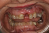 Fig 6. Deep bite, excessive wear, and missing No. 9 present a challenging case for restorative rehabilitation.