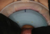Fig 8. Placement of the putty matrix in a patient’s mouth.