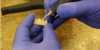 Fig 14. Video of trimming and finishing of the semi-permanent self-cure composite.