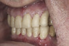 (25.) Provisionals, left lateral, closed view.