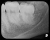 Fig 4. Severe dilaceration of root of tooth No. 17 and
curvature of roots of No. 18. Mandibular canal and inferior border of mandible are
easily visualized. If extraction of No. 17 is planned, a 3D CBCT study is required
due to proximity of tooth root to vascular and inferior alveolar nerve contents of
mandibular canal and possibility of surgical complications.