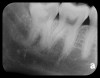 Fig 6. PA radiograph showing 90-degree dilacerations of
mesial and distal roots of tooth No. 32 and intersection of mandibular
canal with these roots. Extraction of tooth No. 32 requires 3D study, and
patient was advised as to this necessity.