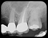 Fig 9. Endodontic obturation overfill visible on PA radiograph, which is
escaping the apex of tooth No. 14 and extruding into the left maxillary
sinus. A pathologic sinus congestion, in the form of a slight radiopacity
within the sinus, is noted in response to the foreign material.