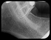 Fig 10.
A hemostat was used to obtain this PSP PA image of a potential fixed
prosthesis abutment, tooth No. 32. The hemostat is visible in the upper
left corner of the image. Hemostat stabilization of an HW sensor is
not possible and can damage the sensor if attempted.