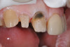 Fig 4. In an attempt to hide the darker color, dentin is removed facially and subgingivally to allow room for opaquing composite.