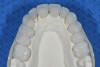 Fig 8. Anterior and posterior zirconia restorations are made.