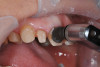 Fig 9. After temporary removal, the teeth are cleaned with pumice and chlorhexidine.