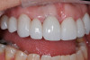 Fig 10. Monolithic zirconia restorations are tried in with water.