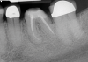 (1. ) Two-dimensional periapical radiograph of tooth No. 19 compared with a CBCT scan slice (0.1 mm) of the same tooth, which reveals a well-defined lesion that a patient can more easily understand.