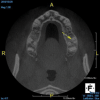 (4.) In a CBCT image axial view, the MB1 and MB2 canals are readily visible in tooth No. 14, and in the coronal view, these two separate canals can be seen to merge into a single apical opening.