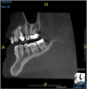 (5.) In a CBCT image axial view, the MB1 and MB2 canals are readily visible in tooth No. 14, and in the coronal view, these two separate canals can be seen to merge into a single apical opening.