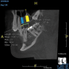 (7.) Treatment planning an implant case is made easier and more accurate by virtually placing implants of the chosen length and diameter and measuring the desired mesiodistal spacing prior to surgery.