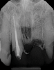 (11.) A pathosis apical to the maxillary central incisors was initially not diagnosed after evaluating the periapical film; however, the CBCT image revealed its presence. Only using the CBCT image could it be determined that the lesion was not odontogenic in origin and that it did not involve the nasopalatine foramen. This diagnosis was supported by a referral to an oral and maxillofacial radiologist.