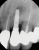 (12.) Immediate postoperative digital radiograph demonstrating the graft material in place.