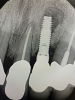 (15.) Follow-up 5-month postoperative radiographs demonstrating healing.