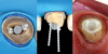 (6.) Occlusal and buccal views showing placement of accessory posts and occlusal view of the completed buildup.