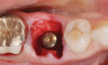 (2.) This series of clinical images illustrates the use of an implant with well-defi ned
threads that improve lateral bone engagement. In a multirooted extraction socket where there are large voids, this can help to achieve initial implant stability.