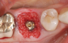 (3.) This series of clinical images illustrates the use of an implant with well-defi ned
threads that improve lateral bone engagement. In a multirooted extraction socket where there are large voids, this can help to achieve initial implant stability.