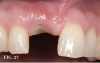 (27.) View of an immediate implant site 2-weeks postoperatively. Note the ideal design of the custom healing abutment supporting and guiding the marginal gingiva.