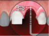 (5.) Depiction of bone sounding revealing a 1-mm deep ovate pontic site with less than 2 mm of tissue remaining between the base of the site and the alveolar bone.