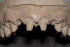 (9.) Ovate pontic sites created on the master cast by the laboratory.