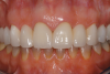 (13.) Close-up retracted 2-month postoperative view of the final fixed partial dentures spanning teeth Nos. 6 through 8 and teeth Nos. 9 through 11, along with replacement crowns for the other restored maxillary teeth.
