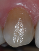 (6.) Pretreatment photograph of an intrinsically stained tooth.