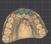 (12.) View of the digital design showing the optimal access location achieved with an angulated screw channel for the tooth No. 10 restoration. Note the less-than-ideal access position that would result from a straight screw channel, highlighted in red, which would be visible on the incisal edge and facial surface.