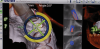 (14.) View of the dynamic 3D navigation system that was used to ensure ideal implant position.