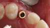 (18.) Assessment of where the relative position of the screw access channel will be from the incisal view.