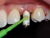 (19.) The abutment was coated with a composite bonding resin on the incisal half.