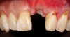 (45.) A patient presented for the replacement of the maxillary left central incisor with a bonded pontic made from the natural tooth, which was removed.