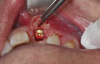 (46.) Occlusal view of the implant after placement.
