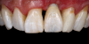 (56.) The provisional restoration was delivered and tightened to 15 Ncm while applying counter torque. Note that there is no pressure on the surrounding tissues and that the gingival embrasures were left open to allow for maximum incisal migration of the gingiva and papillae. The palatal and incisal surfaces were evaluated and modified to ensure that there was no contact throughout the excursive range.