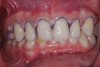 (2.) Minimal tooth preparation was completed to obtain a margin for the veneers while conserving as much enamel as possible. Gingival retraction cord was packed, and a final impression was made with a vinyl polysiloxane impression material.